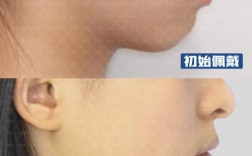 下颌后缩正畸案例，矫正方法有哪些？效果如何？关键点是什么？