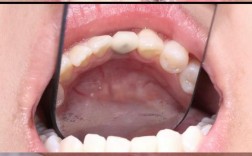 牙周手术和种牙，哪个该先做？效果差异大吗？