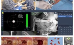 什么是水激光种牙？与传统种牙有何区别？