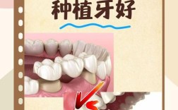 镶牙和种牙到底哪个更适合自己？不同牙齿缺失情况、预算和口腔条件下，哪种修复方式更优？