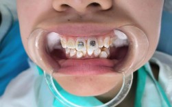 怀孕期间做牙齿正畸矫正安全吗？