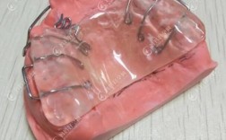 上推簧非拔牙正畸，如何避免拔牙又能有效矫正牙齿？