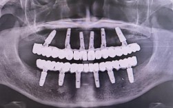 江苏口腔种牙多少钱？正规医院怎么选？
