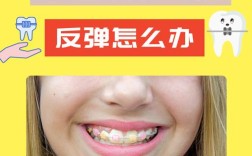 微正畸矫后会反弹