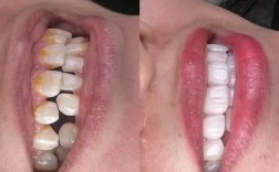 矫正牙齿后出现大牙缝，是矫正不当还是正常现象？