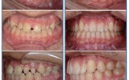 正畸时尖牙为何拉不动？原因大揭秘