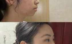 正畸后嘴会变皱