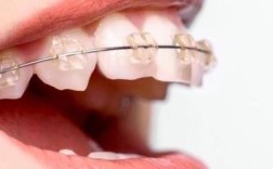 正畸中粘托槽是如何