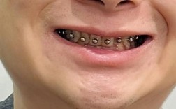 临时冠可以正畸吗