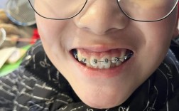 正畸虎牙脸会垮吗