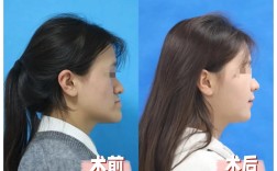 骨性地包天能否通过正畸治疗有效矫正？