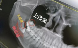 正畸上智齿近中漂移