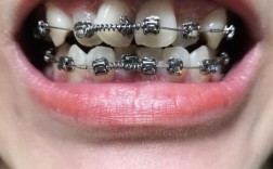 上下咬合不齐矫正有哪些有效方法？