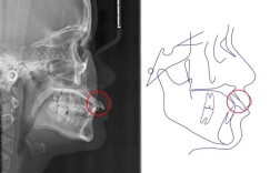 正畸中髁突位置靠前