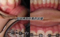 门牙突出矫正哪种方法效果又快又好？