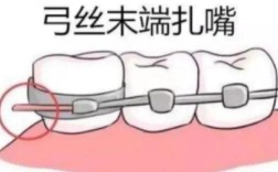 正畸8字结扎的手法