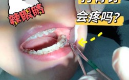 矫正牙齿为啥要打钉子？种植钉到底有啥用？