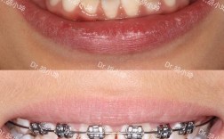 南京7天矫正牙齿真的靠谱吗？效果与安全如何？