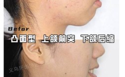偏颌需先手术后正畸？顺序是否科学？效果如何？