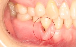 正畸后牙龈萎缩图示？原因、危害及应对方法有哪些？