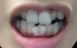 牙齿矫正后牙龈外露，是什么原因导致的牙龈外露现象？