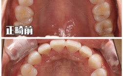 上牙槽骨突出正畸