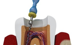 牙髓腔有哪些常用的临床治疗方法？
