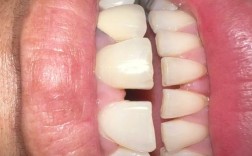 矫正门牙缝大，是什么原因？如何有效解决？