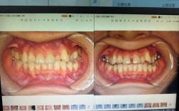 正畸扩弓腭中缝