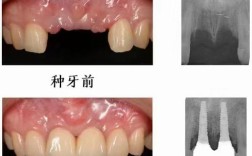 牙周炎下门牙种牙，如何才能顺利种牙呢？