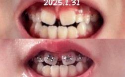 27岁地包天矫正，成年后矫正效果会受年龄影响吗？