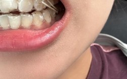 隐形牙齿矫正，拔牙真的需要吗？