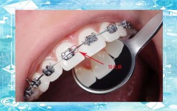 口腔正畸托槽分类