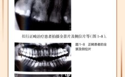 食物嵌塞后，家庭护理（如牙线、冲牙器）与专业治疗（如补牙、牙周治疗）哪种更有效？不同嵌塞程度该如何选择最佳方案？