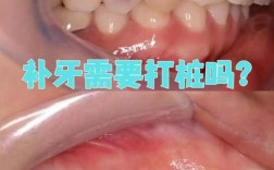 补牙打桩和种牙，牙齿修复该如何正确选择？