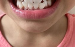 正畸期间牙齿脱矿图片能说明什么问题？