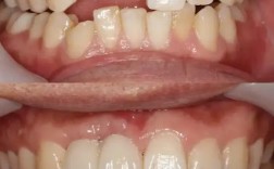 正畸有颗牙活动了