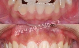 矫正下面一排牙齿效果如何？