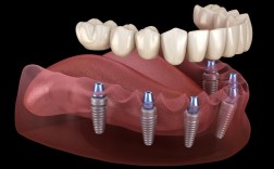 母亲节看种植牙图片，该不该作为健康礼物？