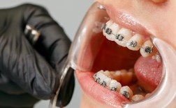 牙齿矫正有假牙