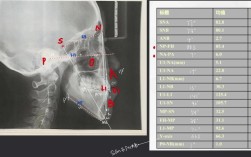 正畸模型测量分析视频具体演示了哪些关键测量指标？不同错颌类型的测量重点有何差异？