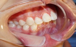 口腔正畸照片拍摄角度的选择有哪些关键标准？不同角度如何精准捕捉牙齿与颌骨信息以影响矫正方案制定？