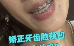 牙齿矫正后脸颊凹陷