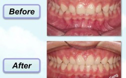 正畸调整咬合，究竟对牙齿功能有何关键作用？