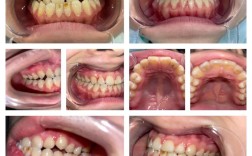 牙齿矫正中大牙后移有何作用？过程和注意事项有哪些？