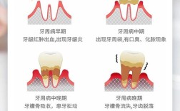 种牙后是否真的会诱发牙周炎？这些风险要了解