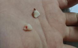 矫正牙齿门牙掉了