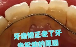 牙齿矫正后牙齿会松动吗？这是真的吗？