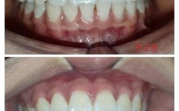 前牙凸矫正案例，为何这样矫正？效果如何？