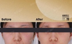 牙齿正畸毁灭脸型